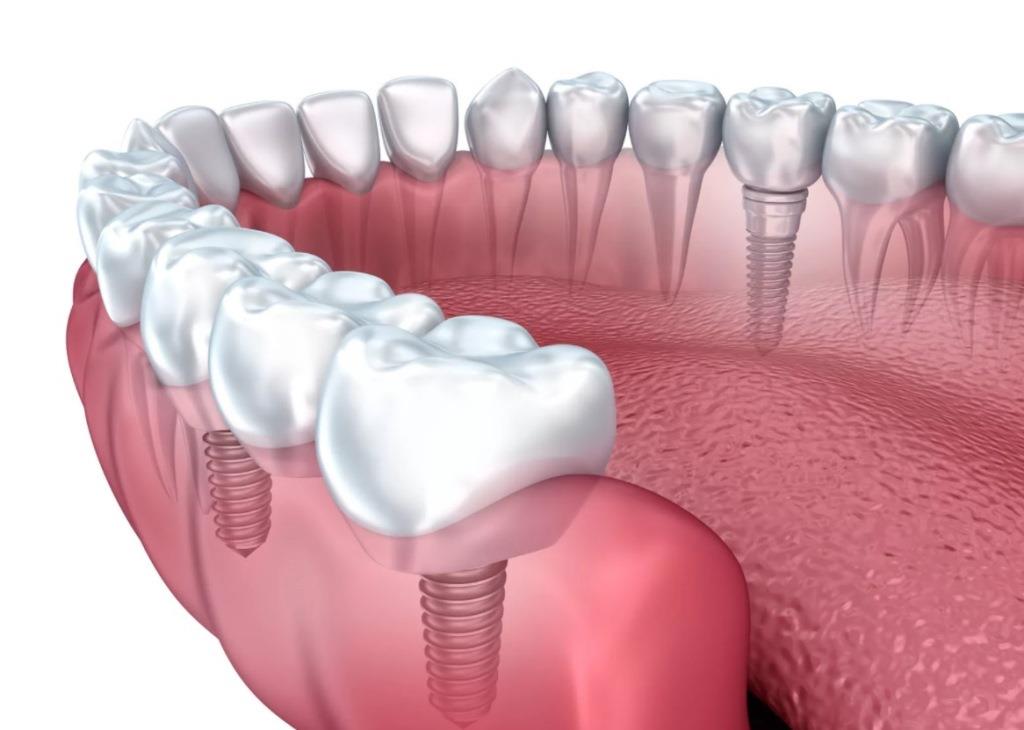 Способы протезирования зубов