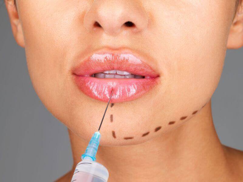 Как проводится контурная пластика губ?