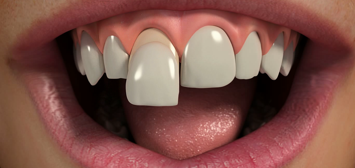 Что такое виниры на зубы