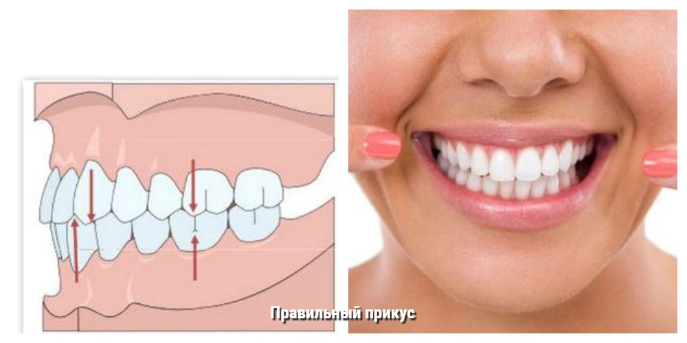 Определение правильного прикуса: как он должен выглядеть и что это означает для здоровья зубов